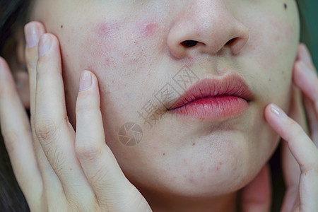 皮肤脸部的骨灰和伤疤 塞巴塞氏腺紊乱 少女皮肤护理美容问题肤色疾病青春期青少年卫生缺陷女孩女士毛孔瘢痕图片