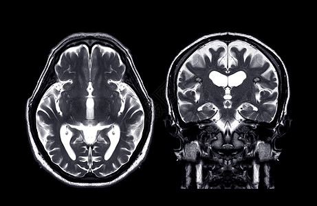 MRI 脑核磁共振二氧化T2和日冕t2f技术图片