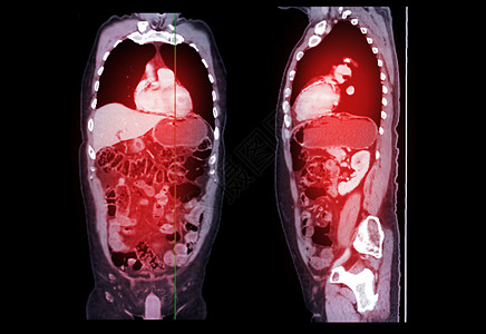切斯特和阿卜杜门的验尸和外观扫描阀门船只肾脏身体支气管药品病人骨盆疾病图片