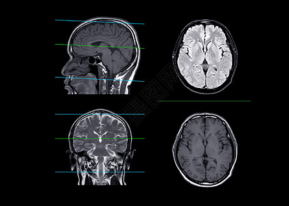 MRI 脑部对比轴 日冕和人造平面图片