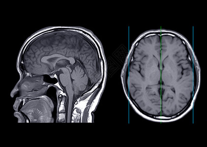 核磁共振脑轴T1W平面射线和轴视图片