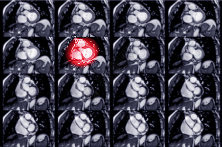 心肌梗塞或心肺复苏诊断核磁共振中风谐振射线扫描胸部心律失常动脉心电图图片