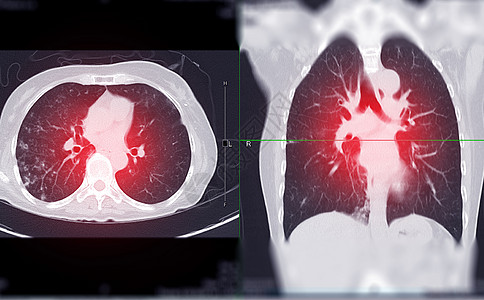CT 肺轴心和射线视图的切片或切片扫描图片