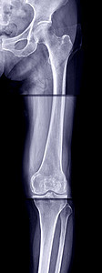 臀部关节 腿骨和膝盖的X光片图片