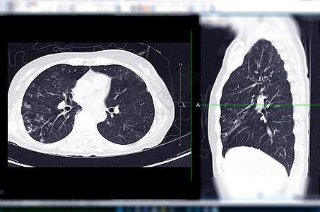 CT 肺轴和验尸视图的切片或切片扫描解剖学主动脉检查注射医院肺部流感癌症传染病呼吸系统图片