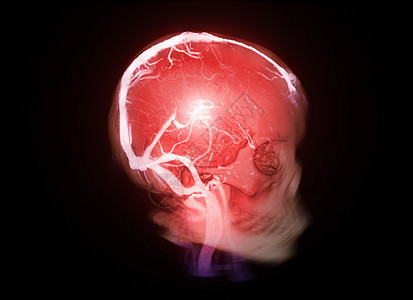 3D和CTV脑部显示 肺结肠鼻腔炎 诊断为静脉脊髓栓塞图片