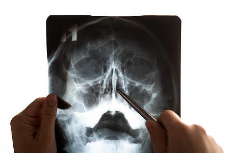 医生检查鼻腔的X光片x光鼻窦解剖学治疗诊断医师核磁共振外科疾病颅骨图片