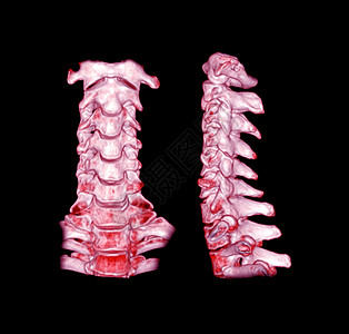 CT 子宫颈脊椎3D剖析 SCAN射线疝气病人骨科伤害疾病扫描创伤脖子颈椎图片