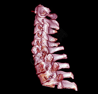 CT 子宫颈脊椎3D剖析 SCAN颈椎颈部创伤椎骨技术骨骼脖子颈椎病脊柱诊断图片