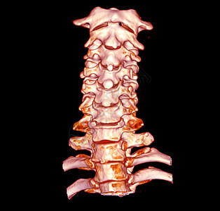 CT 子宫颈脊椎3D剖析 SCAN颈椎病疾病创伤骨骼疝气颈椎诊断脊柱痛苦螺丝图片