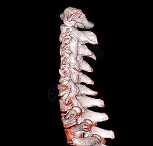 CT 子宫颈脊椎3D剖析 SCAN骨科技术扫描颈部创伤颈椎放射科疾病螺丝伤害图片