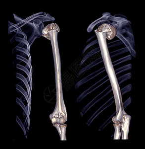 肩膀和humerus骨或手臂的CT扫描诊断锁骨解剖学痛苦放射科肱骨事故病人弯头骨骼图片