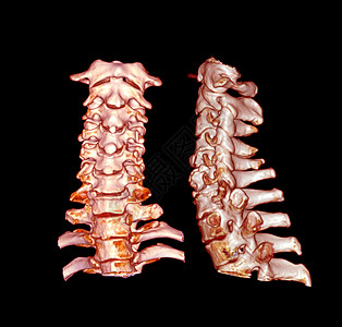 CT 子宫颈脊椎3D剖析 SCAN颈椎病人扫描椎骨射线骨科疼痛伤害诊断颈部图片