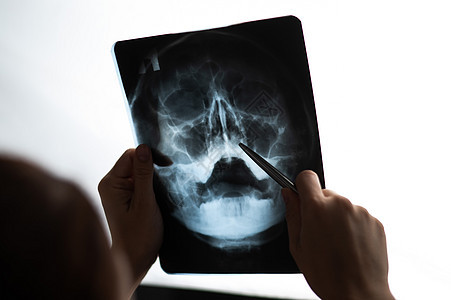 医生检查鼻腔的X光片医师扫描放射科诊断手术鼻窦科学核磁共振药品卫生图片