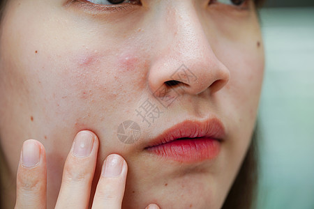 皮肤脸部的骨灰和伤疤 塞巴塞氏腺紊乱 少女皮肤护理美容问题皮脂腺药品前额青春期女孩毛孔化妆品产品肤色治疗图片