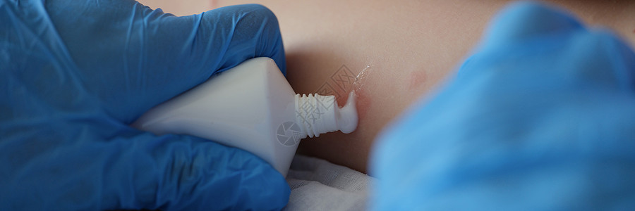 医生在医院检查婴儿腿部的红疹子 从管子里涂奶油图片
