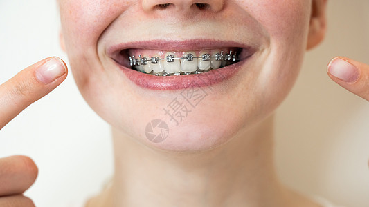 一个年轻女人的近距离肖像 指着她牙齿上有牙套的笑容快乐微笑卫生治疗嘴唇搪瓷女性医生女士裁剪图片