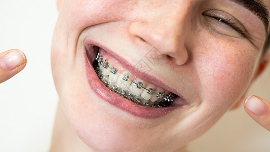一个年轻女人的近距离肖像 指着她牙齿上有牙套的笑容裁剪治疗牙医女士浴室快乐矫正嘴唇药品压力图片