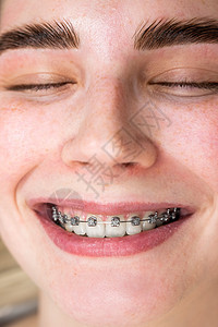 一个年轻女人的近身微笑 牙齿上有牙套技术嘴唇浴室女性矫正卫生搪瓷宏观女士压力图片
