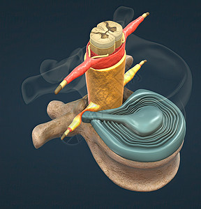 滑动盘也可以称为折叠或嵌入盘片颈椎病光盘脊椎外科骨干腰椎脊髓药品骨科科学图片