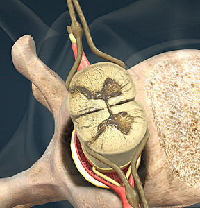 滑动盘也可以称为折叠或嵌入盘片脊柱椎骨疝气药品脊髓解剖学骨科疾病外科教育图片