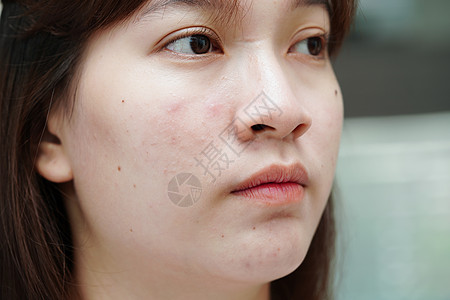 皮肤脸部的骨灰和伤疤 塞巴塞氏腺紊乱 少女皮肤护理美容问题药品皮脂腺青春期治疗缺陷瘢痕皮肤科前额感染卫生图片