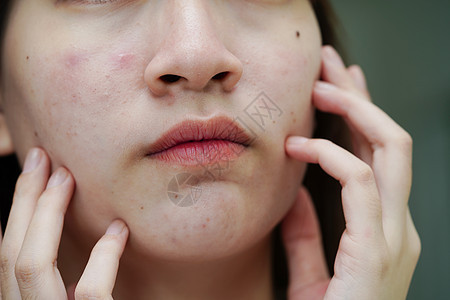 皮肤脸部的骨灰和伤疤 塞巴塞氏腺紊乱 少女皮肤护理美容问题青少年产品女孩感染皮肤科瘢痕缺陷青春期化妆品前额图片