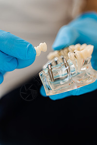 人造塑料下巴与牙种植体特写 假牙和植入物 为牙科患者女性咨询牙医的假牙咨询乐器技术员医院医生考试治疗口腔科药品实验室矫正图片