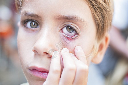 近距离接近儿童眼部 脑膜炎症药品疼痛症状宏观眼皮皮脂睑板感染配镜师女孩图片