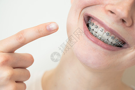 一个年轻女人的近距离肖像 指着她牙齿上有牙套的笑容治疗牙科矫正技术裁剪女士金属压力微笑搪瓷图片