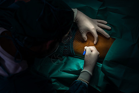外科医生在手术前用消毒注射器向病人注射麻醉剂护士技术团队疾病手套治疗保健卫生医护人员操作图片