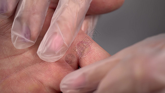 医生检查一个男人手上的骨 苍蝇皮肤病 亲近手图片