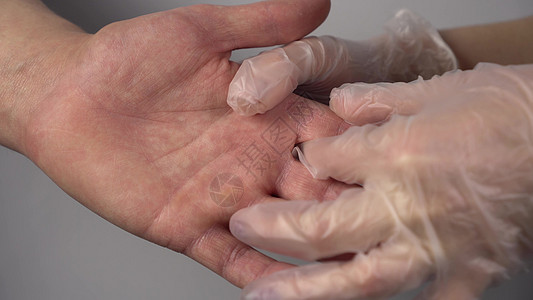 医生检查一个人手上的真菌病 手指上的呼噜声 手紧点图片