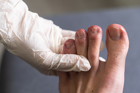 咬着一个人的脚趾低角度手臂动物昆虫学危险蜘蛛成人蠕变拇指指甲图片
