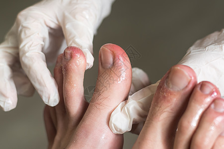 咬着一个人的脚趾治疗低角度昆虫指甲成人药品蜘蛛网络地面动物图片