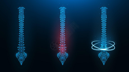 人类脊椎的多角矢量说明 健康 生病和正在恢复的脊椎图像图片
