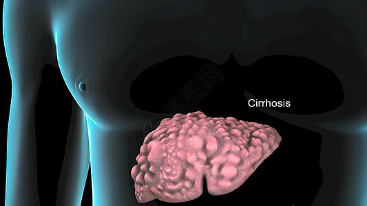 硬化是肝脏长期和持续受损的结果 因此导致出现慢性硬化 肝硬化 成人图片