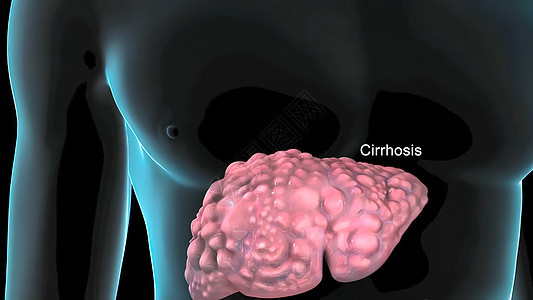 硬化是肝脏长期和持续受损的结果 因此导致出现慢性硬化 肝硬化 外科手术图片