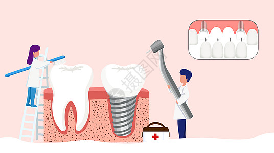 种植牙齿背景图插画高清图片