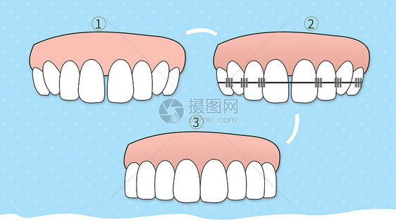 牙齿纠正图片