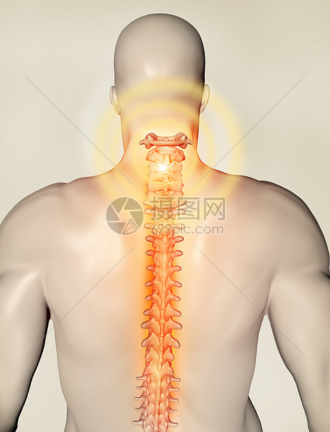 背部颈椎骨折图片