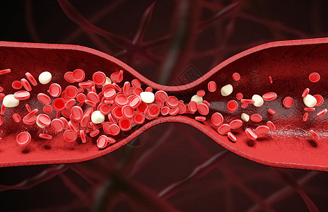 血管狭窄白血细胞高清图片
