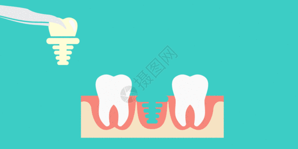 牙医拔除坏掉牙齿插画GIF高清图片