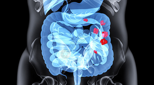肿瘤肠道疾病场景设计图片