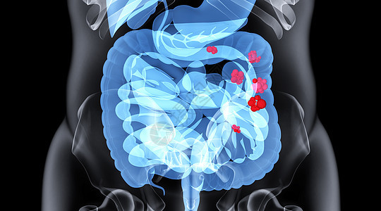 肠道疾病场景图片