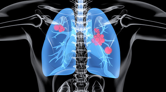 肺部疾病场景图片