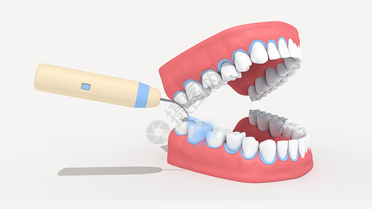 洗牙医疗洁牙高清图片