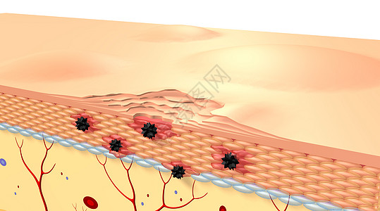 皮肤病变场景高清图片