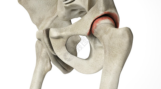 骨盆骨骼病变场景设计图片