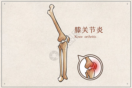 膝盖解剖膝关节炎示意图插画